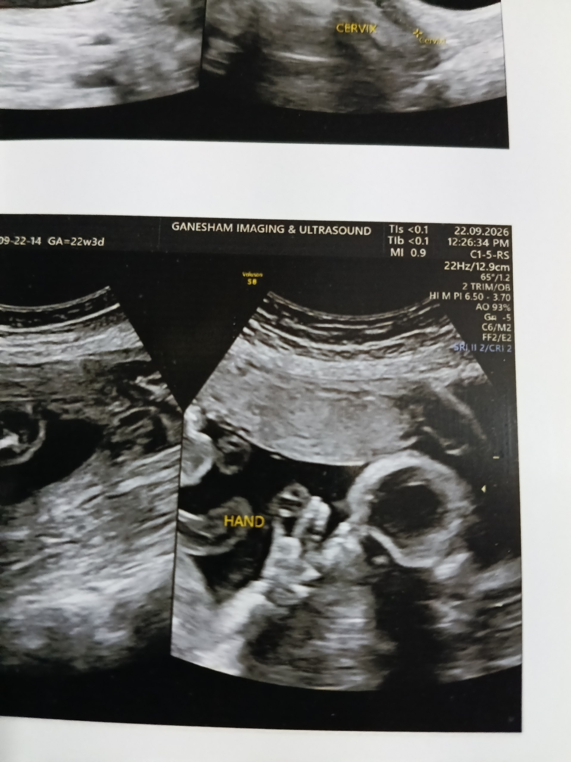 Baby Sonography Scan